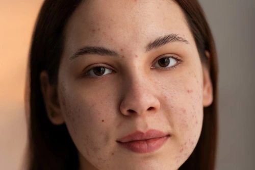 Dermal Fillers
