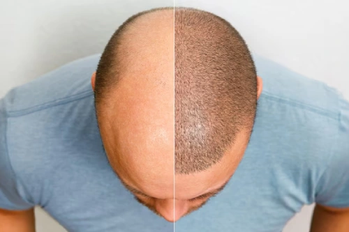Hair Transplant (FUE/FUT)